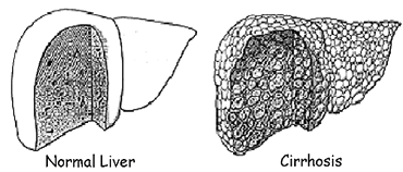 cirrhosis versus normal liver image